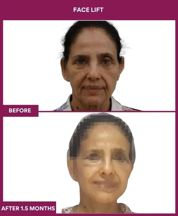 facelift-surgery-before-after-results-mumbai-patient10-front