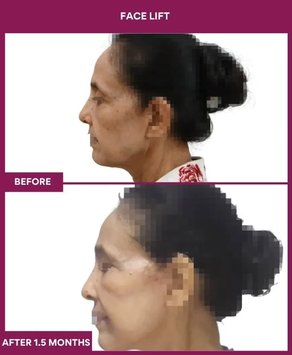 facelift-surgery-before-after-results-mumbai-patient10-side-left
