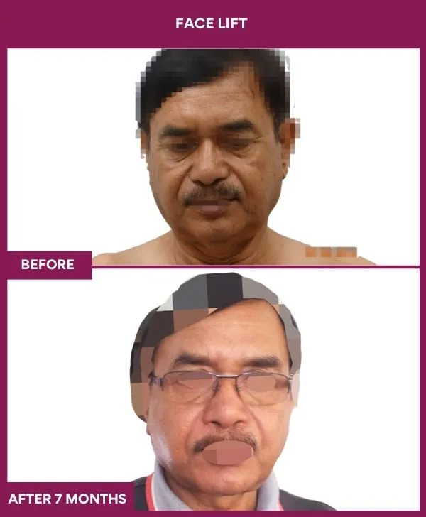 facelift-surgery-before-after-results-mumbai-patient11-front