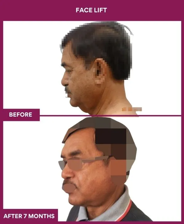 facelift-surgery-before-after-results-mumbai-patient11-side-left