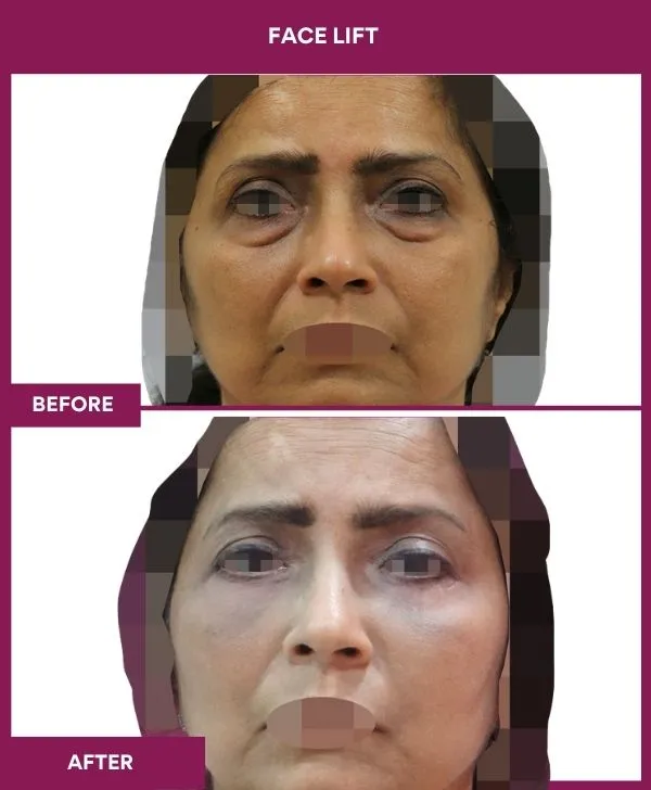 facelift-surgery-before-after-results-mumbai-patient12-front