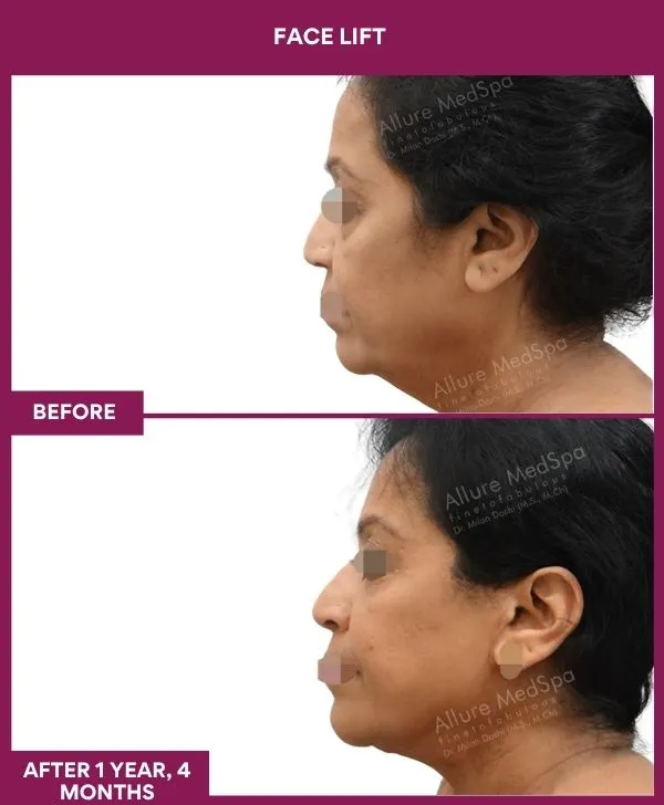facelift-surgery-before-after-results-mumbai-patient13-side-left