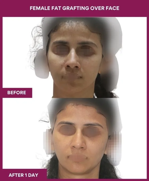 facial-fat-transfer-before-after-results-mumbai-india-patient07-front