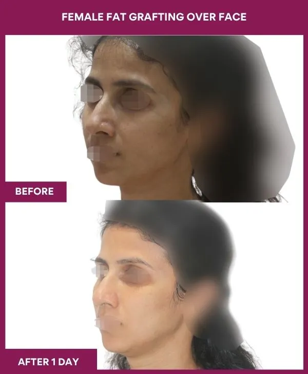 facial-fat-transfer-before-after-results-mumbai-india-patient07-side-left