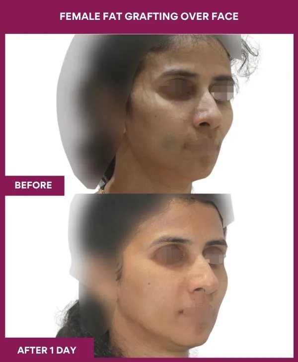 facial-fat-transfer-before-after-results-mumbai-india-patient07-side-right