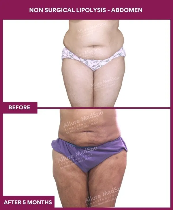 non-surgical-lipolysis-abdomen-before-after-results-mumbai-india-patient01-side-front
