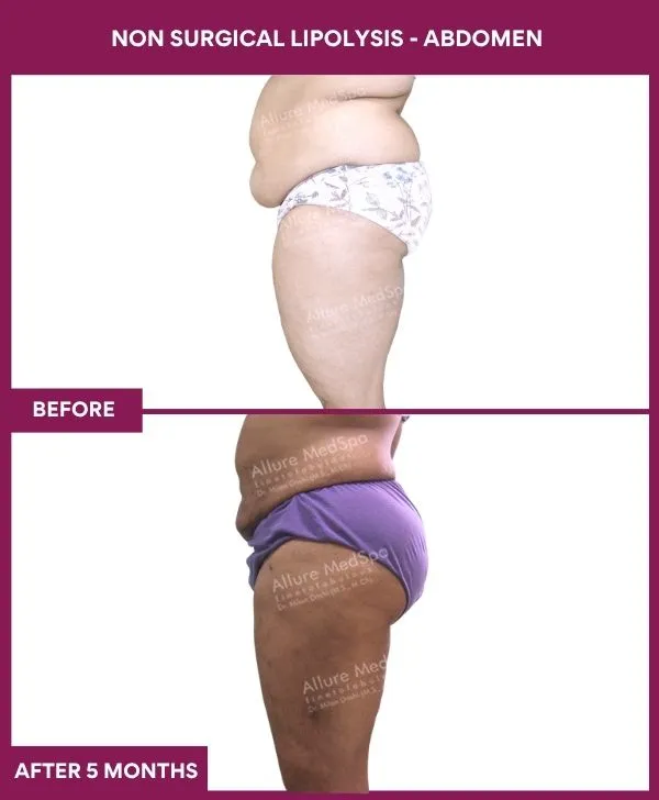 non-surgical-lipolysis-abdomen-before-after-results-mumbai-india-patient01-side-left