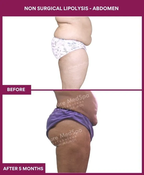 non-surgical-lipolysis-abdomen-before-after-results-mumbai-india-patient01-side-right
