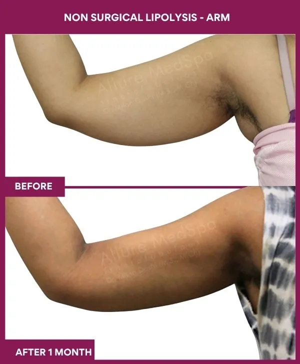 non-surgical-lipolysis-arm-before-after-results-mumbai-india-patient02-side-left