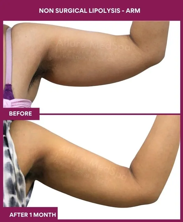 non-surgical-lipolysis-arm-before-after-results-mumbai-india-patient02-side-right