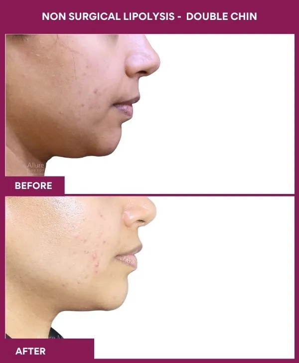 non-surgical-lipolysis-double-chin-before-after-results-mumbai-india-patient03-side-right