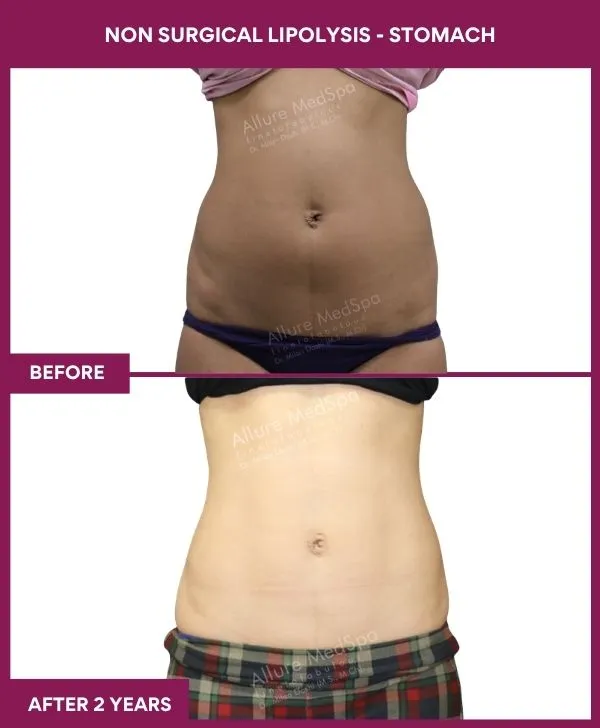 non-surgical-lipolysis-stomach-before-after-results-mumbai-india-patient04-front