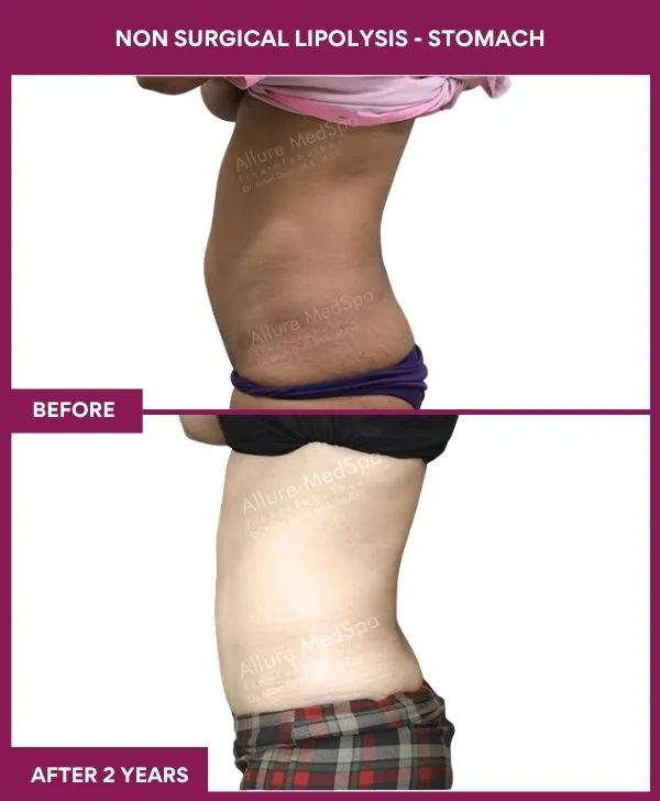 non-surgical-lipolysis-stomach-before-after-results-mumbai-india-patient04-side-left