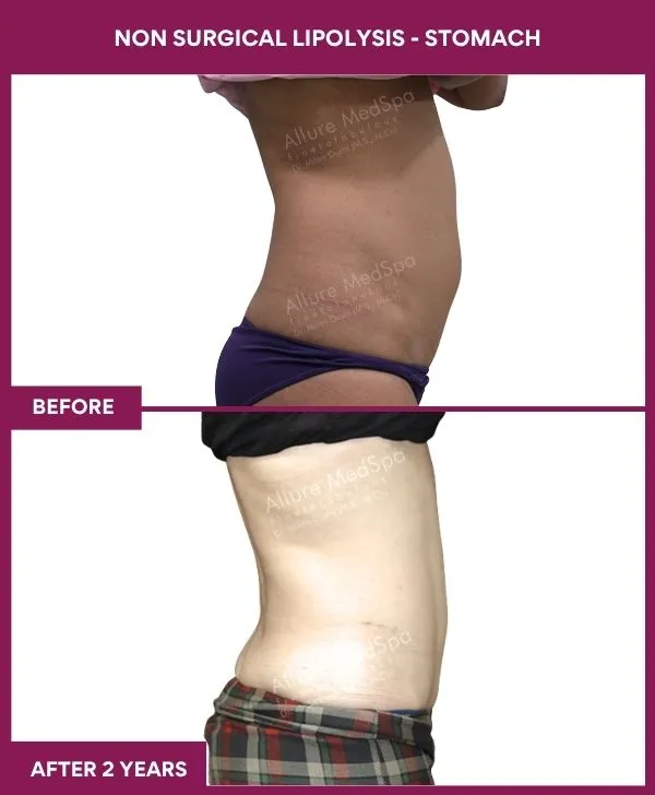 non-surgical-lipolysis-stomach-before-after-results-mumbai-india-patient04-side-right