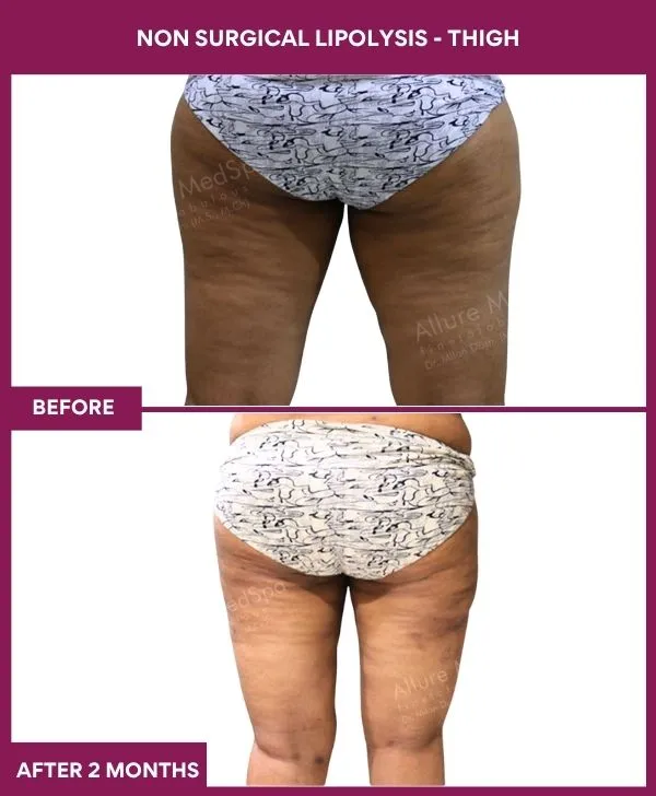 non-surgical-lipolysis-thigh-before-after-results-mumbai-india-patient05-side-back