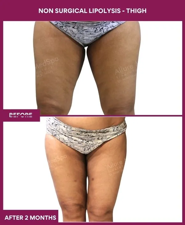 non-surgical-lipolysis-thigh-before-after-results-mumbai-india-patient05-side-front