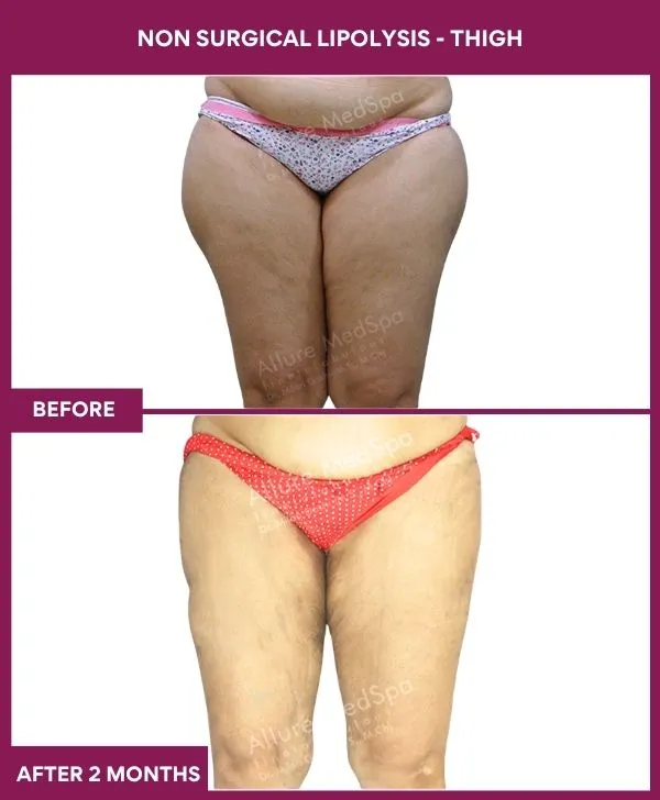 non-surgical-lipolysis-thigh-before-after-results-mumbai-india-patient06-side-front