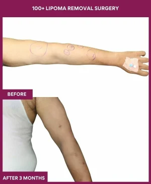 1 100+ Lipoma Removal Surgery (3)