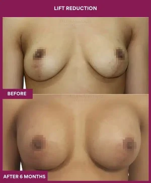 1 Lift reduction