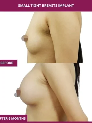 1 Small Tight Breasts Implant (2)_1