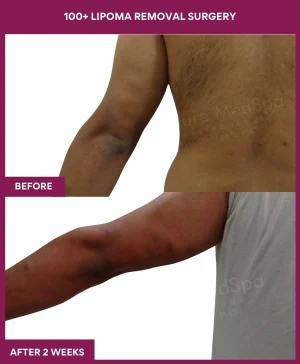 10 100+ Lipoma Removal Surgery (3)