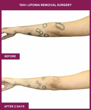 100+-lipoma-removal-arm-before-after-results-mumbai-india-patient07-side-left