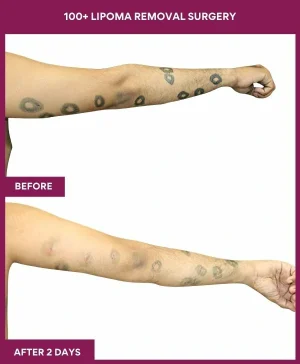 100+-lipoma-removal-arm-before-after-results-mumbai-india-patient07-side-right