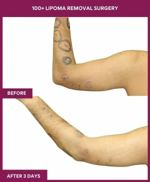 100+-lipoma-removal-arm-before-after-results-mumbai-india-patient10-back-left