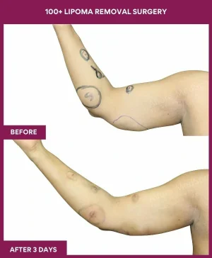 100+-lipoma-removal-arm-before-after-results-mumbai-india-patient10-side-left