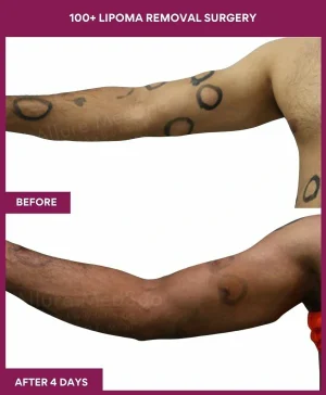 100+-lipoma-removal-arm-before-after-results-mumbai-india-patient12-back-left