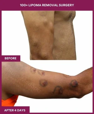 100+-lipoma-removal-arm-before-after-results-mumbai-india-patient12-back-right