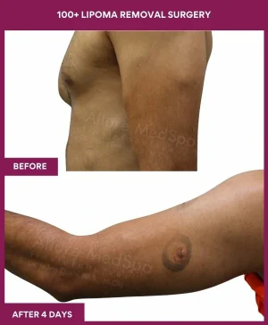 100+-lipoma-removal-arm-before-after-results-mumbai-india-patient12-side-left