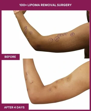 100+-lipoma-removal-arm-before-after-results-mumbai-india-patient15-side-left