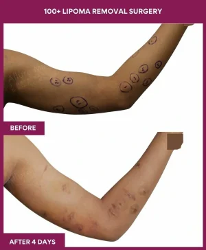 100+-lipoma-removal-arm-before-after-results-mumbai-india-patient15-side-right