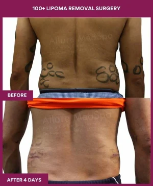 100+-lipoma-removal-back-before-after-results-mumbai-india-patient12