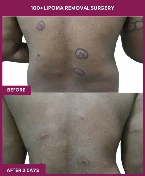 100+-lipoma-removal-back-before-after-results-mumbai-india-patient15