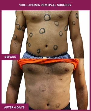 100+-lipoma-removal-stomatch-before-after-results-mumbai-india-patient12-front