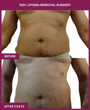 11 100+ Lipoma Removal Surgery