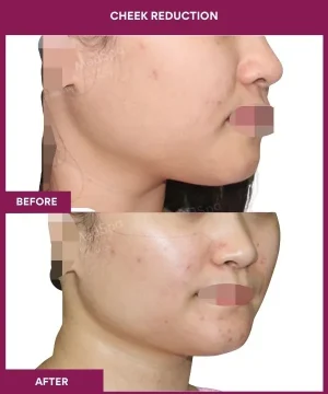 11 Cheek Reduction (2)_29_