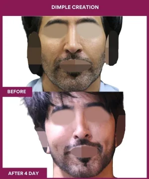 Male Dimpleplasty in mumbai, India