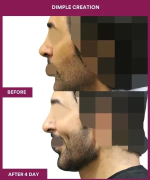 Male Dimpleplasty in mumbai, India