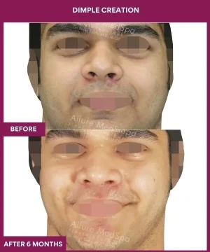 Male Dimple Creation in Mumbai, India