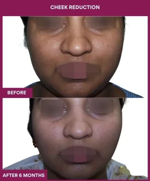 15 Cheek Reduction_34_
