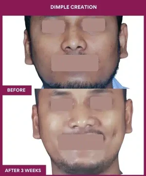 Dimple Creation Surgery in Mumbai, India