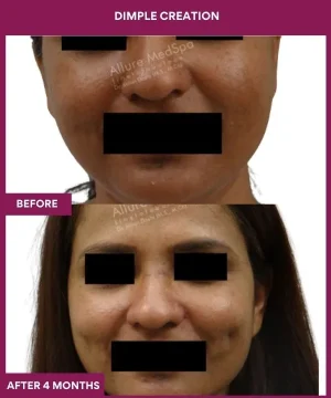 Dimple Creation Surgery in Mumbai, India