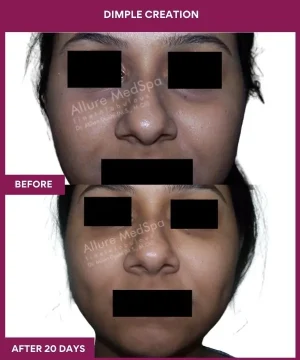 Dimple Creation Surgery in Mumbai, India