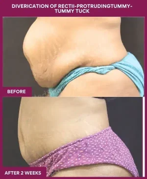 2 DIVERICATION OF RECTII-PROTRUDINGTUMMY- TUMMY TUCK_6_ (5)