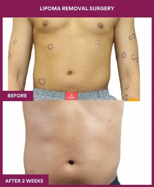 2 Lipoma Removal Surgery