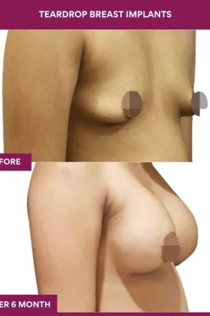 2 Teardrop Breast Implants (5)_5