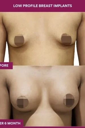 2 low Profile Breast Implants_6